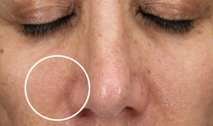 Skinretin Xpert Pack (5 Sesiones)