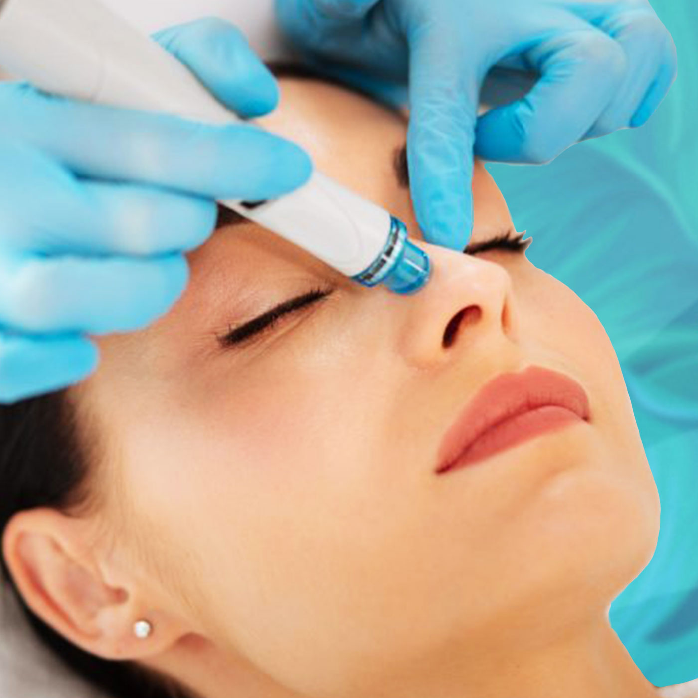 Hydrafacial