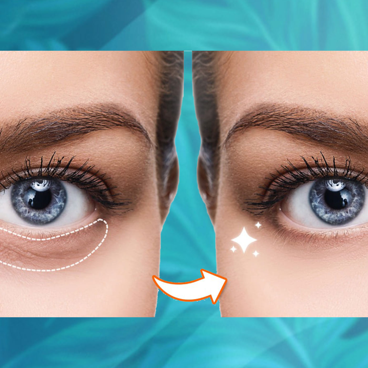 Eyecon Treatment Mesoestetic (6 Tratamientos)