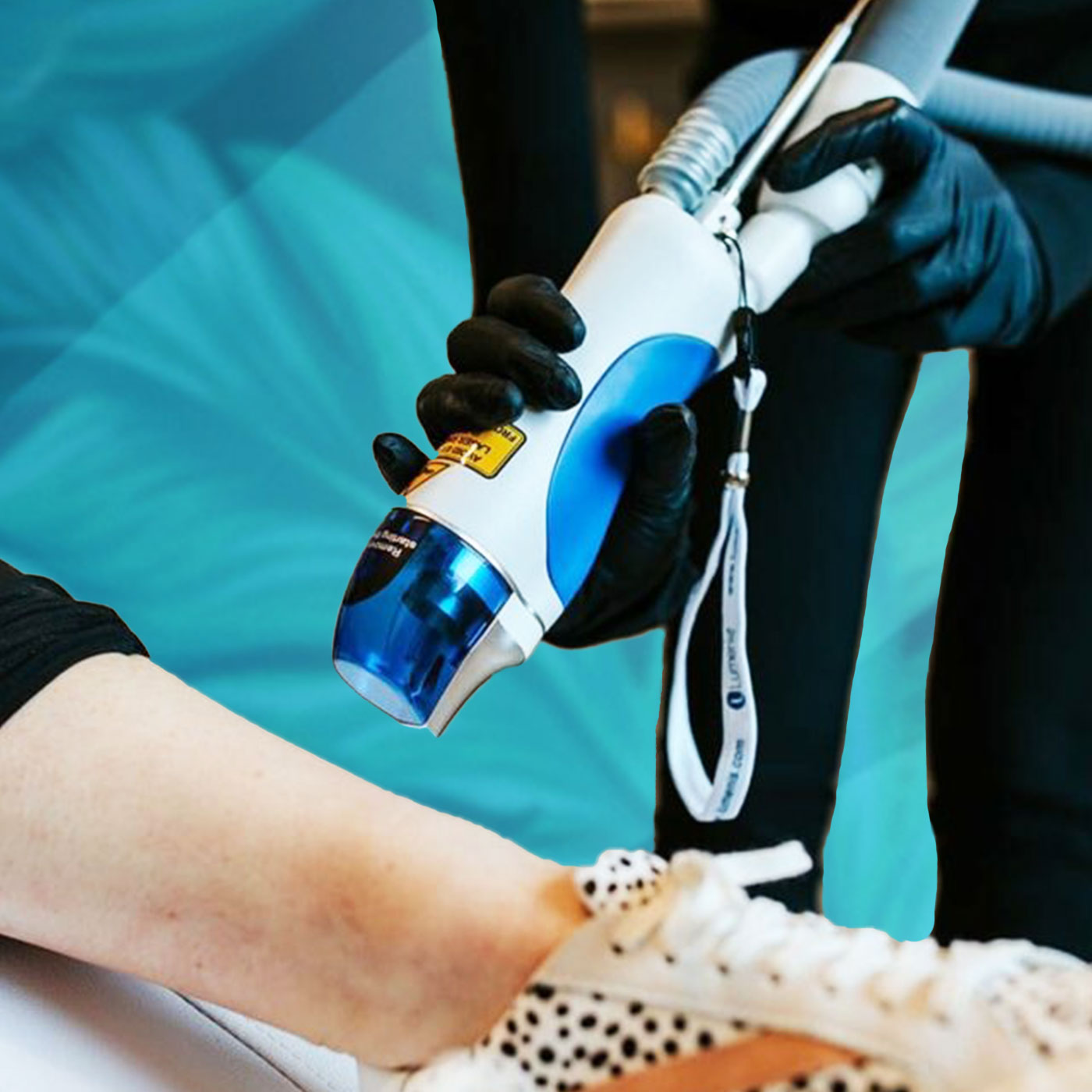 Spider Veins Treatment