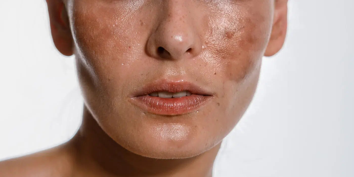 Manchas & Melasma