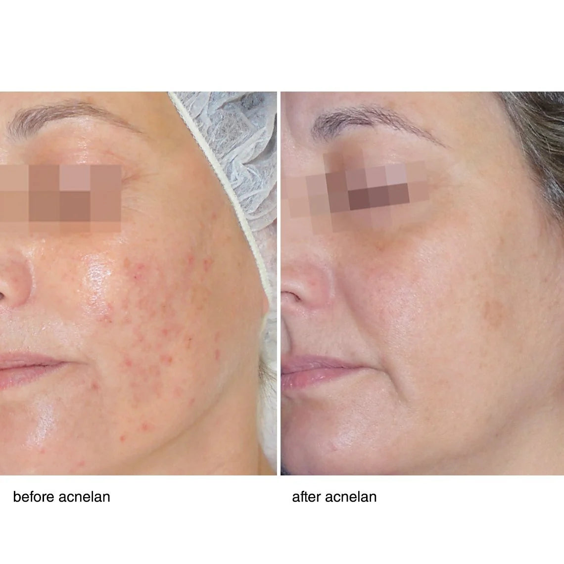 Acne Peel