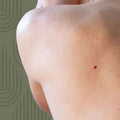 Cherry Angiomas