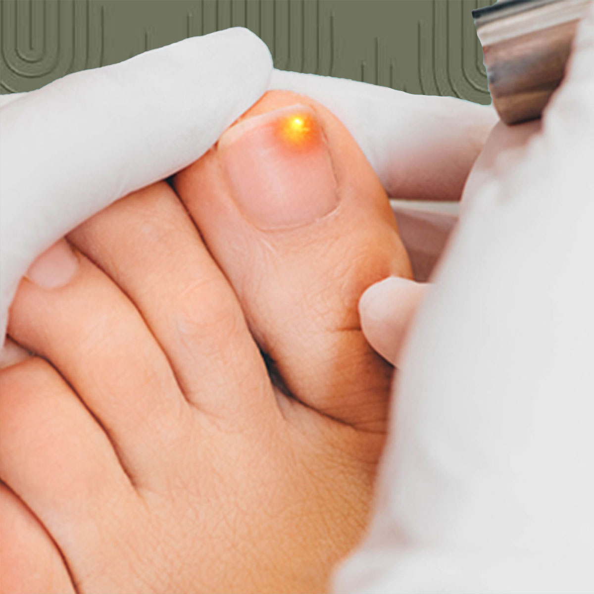 Tratamiento Láser Hongo en Uñas (5 Sesiones)