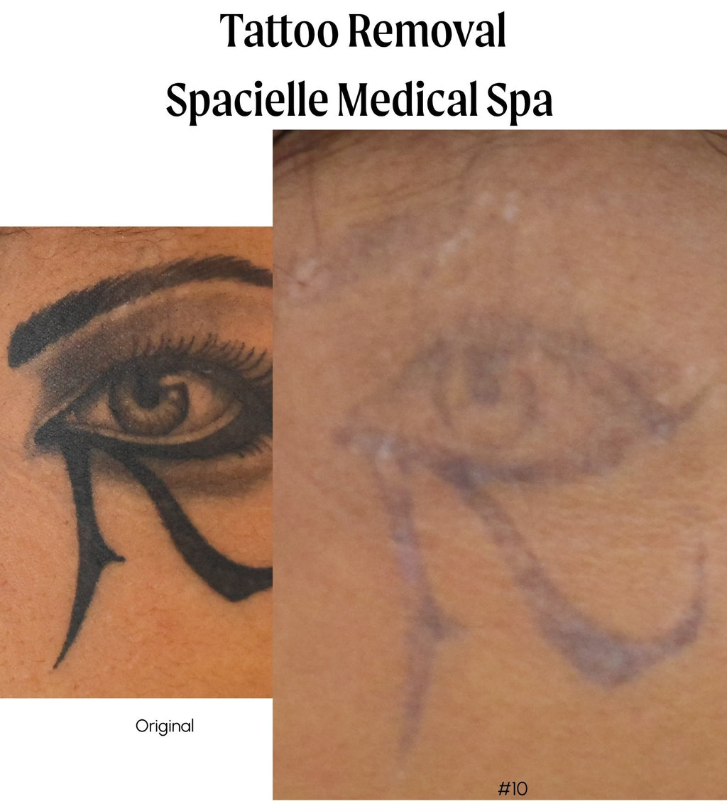 Tattoo Removal