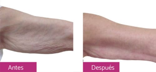 Radiofrecuencia Muslos o Abdomen 6 Sesuiones