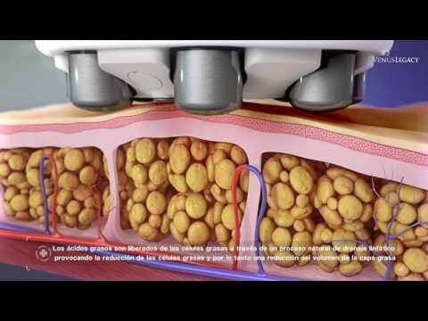 Radiofrecuencia Muslos o Abdomen 6 Sesuiones