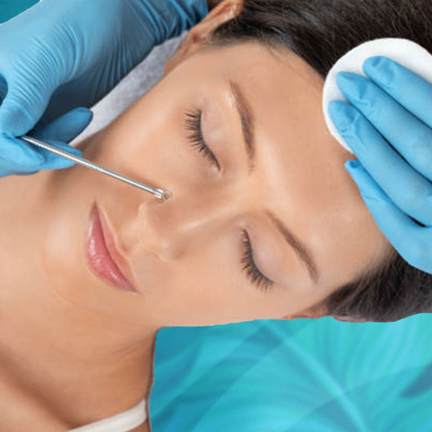 Extracción Facial